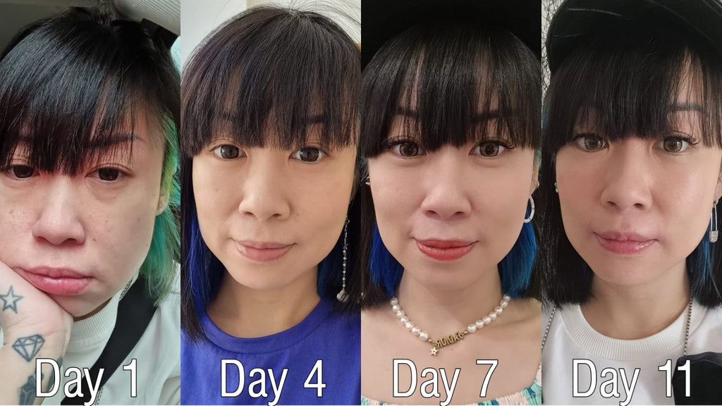 Profhilo Review: The New Injectable Moisturiser (With Before And After Pictures)